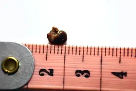 多大的结石需要做经皮肾镜取石术？这种打孔取石对人体有哪些伤害图片