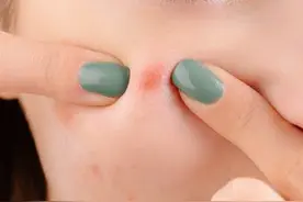 脸颊两侧长痘的原因你知道吗？图片