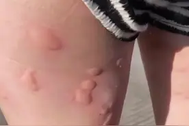 蚊子最大的天敌，不是蚊香？教你4个灭蚊，整晚开窗都不怕图片