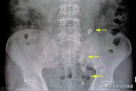 32岁的她肾结石做了软镜手术，术后一年又复发，又是1cm肾结石图片