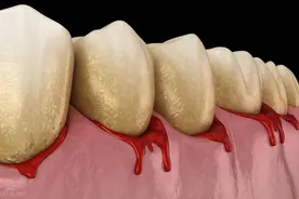 后牙龈发炎肿痛怎么消炎最快图片