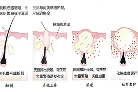不看不知道！原来诱发痘痘的护肤品成分这么多图片