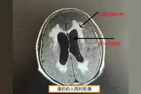 “脑壳进水了”可不是好事！神外医生带你科学认识脑积水！图片