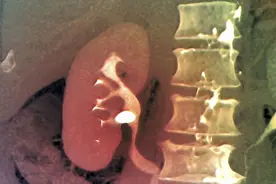 肾小球滤过率下降后能恢复吗？关键在5点，别被血肌酐给误导了图片