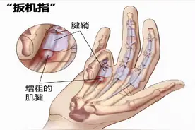 50岁左右的人手指关节疼痛，是不是腱鞘炎，该如何是好？图片