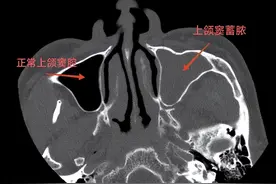 牙源性上颌窦炎：头痛流脓涕，竟是它在作祟！图片