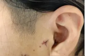 一个超折磨人的病，颞下颌关节紊乱！图片