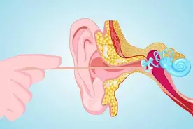 耳屎（耵聍）的去与留图片