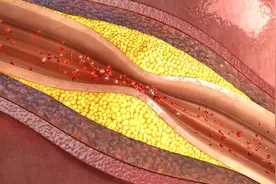 50岁以后，管住5个指标，动脉粥样硬化可能远离你图片