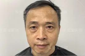 50岁铁了心把眼袋手术做了，术后状态公开，照镜子“傻眼”了图片