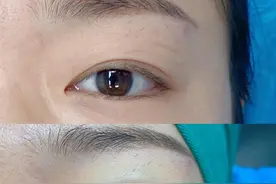 埋线双眼皮多久能恢复自然？术前术后注意事项你必须知道！图片