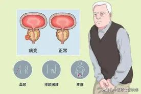 3组联合用药，补肾、祛湿热、化瘀，改善你的“生命腺”图片