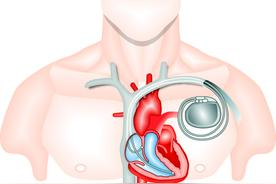 心脏起搏器，当装则装图片