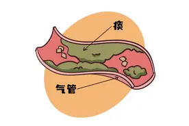 痰堵在气管差点被送走！学会这2招排痰法能救命图片
