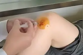 玻璃酸钠治疗膝关节效果怎么样？哪些膝关节问题可以打？图片