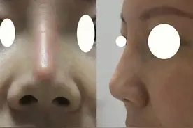 鼻整形界的黑名单，修复之路不好走（第三章）图片