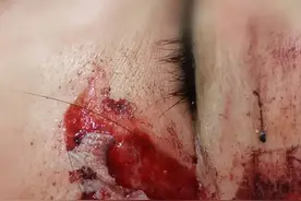 面部受伤，美容缝合，20分钟“不留疤”！图片