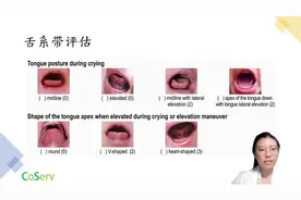如何判断孩子舌系带短吗？图片