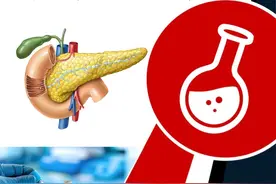 血淀粉酶：胰腺疾病的诊断利器 血淀粉酶，也叫做血清淀粉酶（AMS），就像是我们身体里的“食物分解工”。
它主要的工作是把我们吃进去的米饭、面条等含有淀粉的食物，变成更小的糖分子，这样我们的身体就能更容易地吸收和使用这些糖分来获取能量。
血淀粉酶主要来源于胰腺，像近端十二指肠、肺、子宫、泌乳期的乳腺等器官也会少量分泌。在人体里最常见的是α-淀粉酶，主要存在于血液、胰脏和唾液中。 
在临床上，血清淀粉酶活性测定很有价值，主要用于急性胰腺炎的诊断。
正常情况下，血液中淀粉酶浓度很低，可一旦发生急性胰腺炎，由于胰腺细胞被破坏，淀粉酶就会从胰腺细胞中释放到血液里，导致浓度明显增高。
一般来说，成人血淀粉酶的正常值范围大约在 25 - 125U/L 之间，不过不同的检测方法数值会有所不同。
比如酶速率法（血清）正常值范围在 20 - 90U/L 或 25 - 125U/L 之间，
碘比色（血清）可能达到 800 - 1800U/L，
具体得参考不同医院或实验室的试剂盒标准。 
血淀粉酶升高可能提示很多疾病。
当血淀粉酶数值高于正常值三倍时，就要高度怀疑急性胰腺炎了。
此外，药物、唾液腺疾病、慢性肾功能不全等也可能导致血淀粉酶升高。
而血淀粉酶降低主要见于胰腺疾病造成的胰脏废用，像胰腺全切除、胰腺广泛切除、急性暴发性胰腺炎，还有重症糖尿病、严重肝病等情况。 
大家要注意哦，进行血淀粉酶检测时，要避免使用可能影响检测结果的药物，还要注意别让唾液污染标本。
而且血检结果与进食关系不大，抽血不用空腹。 总之，血淀粉酶是个重要的消化酶，它的水平变化对诊断胰腺疾病等有重要意义。
如果出现相关症状或怀疑有相关疾病，要及时进行血淀粉酶检测，并结合其他临床信息进行准确诊断。
#硬核健康科普行动   #血淀粉酶 #血淀粉酶高是什么原因视频封面