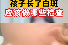 孩子长了白斑 应该做哪些检查