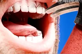 牙齿缺失一小块时该怎么办？动画呈现全过程，超治愈