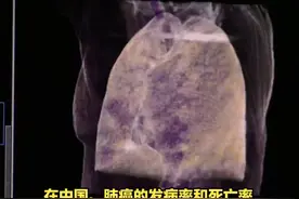 体检时做的胸片上能发现肺结节吗？视频封面