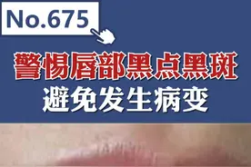 嘴唇的健康 观察唇部颜色是否有局部颜色突然改变，警惕唇部黑点、黑斑。#硬核健康科普行动  #嘴唇发紫 #整形安全官视频封面