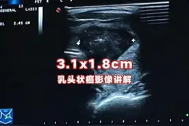 3.1x1.8公分的甲状腺结节乳头状癌影像讲解 #超声学习 #超声影像视频封面