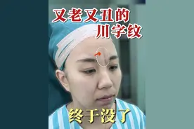 这条又老又丑的川字纹终于没了！ 29岁河北小姑娘川字纹显老显难看、深受困扰，切除恢复好后看着年轻了也漂亮了不少。
#川字纹 #川字纹效果太棒了 #任冲川字纹 #川字纹任冲 #任冲拯救重度川字纹