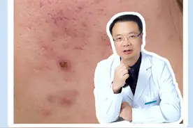 刷酸能不能改善毛孔粗大呢？#皮肤科医生谢红付 #刷酸 #毛孔粗大视频封面