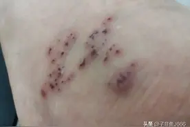 带状疱疹，6月23日第一次去三甲医院皮肤科看医生图片