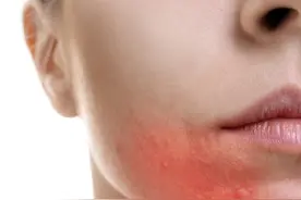 男生长痘是怎么回事？图片