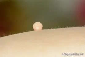 皮肤上冒出来的小肉球、小肉疙瘩是什么？如何处理？图片