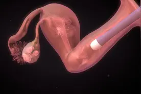 大龄剩女相亲屡次被拒，巨阴症真的无法生育吗？医生为你解答图片