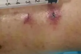 福建一老人被眼镜王蛇咬伤险丧命！家属要求出院，医生极力劝说！图片