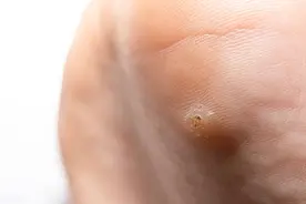 脸上长的瘊子，是HPV感染？1个动作就能传染，还能治好吗？图片
