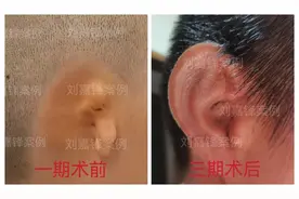 小耳畸形的病因，除遗传因素外，这些因素也可能会导致畸形的发生图片