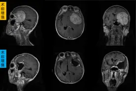 零输血 全切颅内肿瘤——哈医大一院成功救治巨大多血性复杂颅内肿瘤患者图片