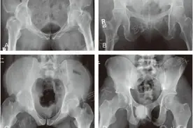 耻骨联合分离的常见诊断要点图片