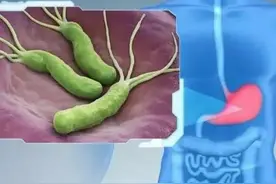 分享治疗幽门螺旋杆菌的一次经历图片