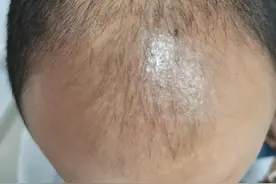 你属于哪一种类型脱发？图片