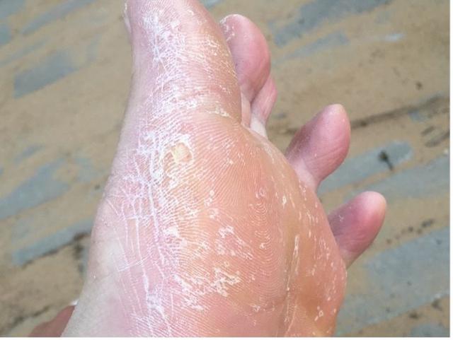 麟屑型角化型脚气