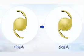 上海眼科院长：一只眼用的单焦晶体，另一只眼可以用多焦晶体吗？图片