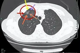 这样典型的带浸润特征（毛刺征）的磨玻璃结节居然是原位癌？图片