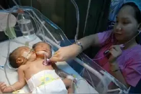 2011年，四川孕妇生下中国第一例“双头女婴”，最后怎样了？图片