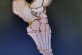 第五跖骨基底部骨折康复记录（更新至第12天——三维重建CT检查）图片