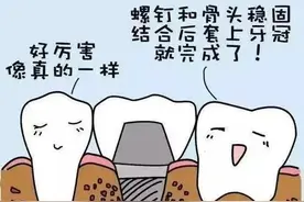 种植牙硬伤"塞牙"？专家表示：越早修复缺牙，概率越低！图片