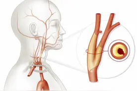 体检发现颈动脉硬化、斑块，生活上要注意这些，可预防血栓图片