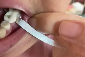 痛苦的种植牙经历图片