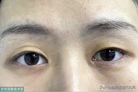 记录40岁的我终于鼓起勇气把全切双眼皮做了，术后6个月的全过程图片